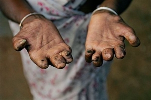 La C&ocirc;te d&rsquo;Ivoire dispose d&eacute;sormais d&rsquo;un traitement "efficace" et "gratuit" contre la l&egrave;pre