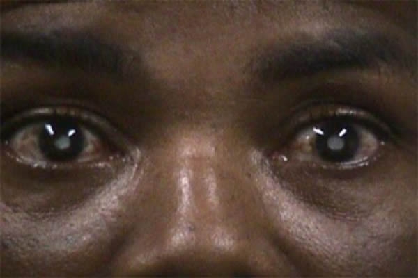 C&ocirc;te d'Ivoire-Sant&eacute;: On cherche 500 malades de la cataracte pour les op&eacute;rer gratuitement