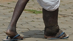 Plus d&rsquo;un milliard de personnes dans le monde souffrent de maladies tropicales n&eacute;glig&eacute;es dans le monde (OMS)