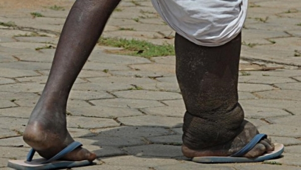 Plus d&rsquo;un milliard de personnes dans le monde souffrent de maladies tropicales n&eacute;glig&eacute;es dans le monde (OMS)