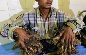 Sant&eacute; : Un &laquo; homme-arbre &raquo; sera bient&ocirc;t op&eacute;r&eacute; au Bangladesh