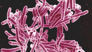 Les cas de tuberculose baissent trop lentement pour atteindre les objectifs fix&eacute;s pour 2020