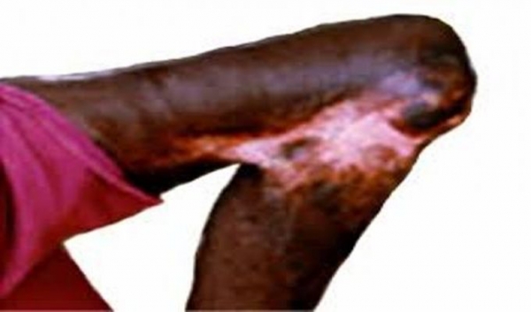 C&ocirc;te d'Ivoire : Plaidoyer pour une synergie d'actions en vue d'&eacute;radiquer l&rsquo;ulc&egrave;re de Buruli