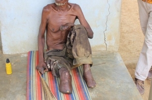 C&ocirc;te d&rsquo;Ivoire : Une vingtaine de nouveaux cas de l&egrave;pre d&eacute;tect&eacute;s &agrave; Dimbokro