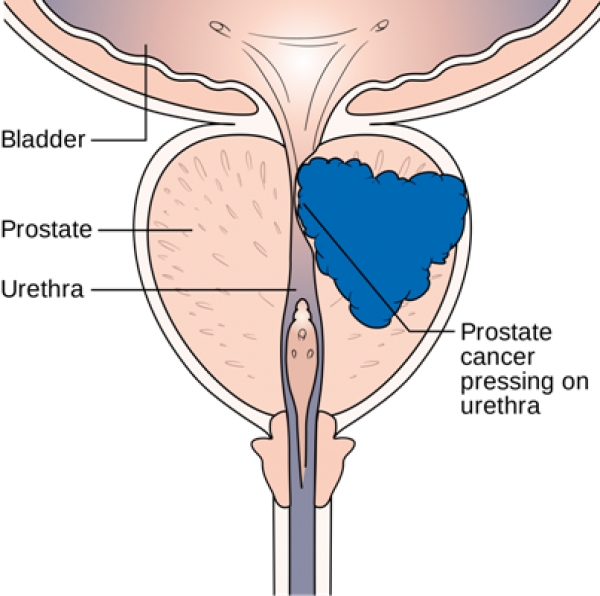 Sant&eacute;-Cancer de la prostate : Le risque de r&eacute;cidive de la maladie double chez les fumeurs, selon l'Institut Curie